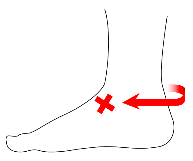 Profile view of a foot’s left side with a red ‘X’ on the instep