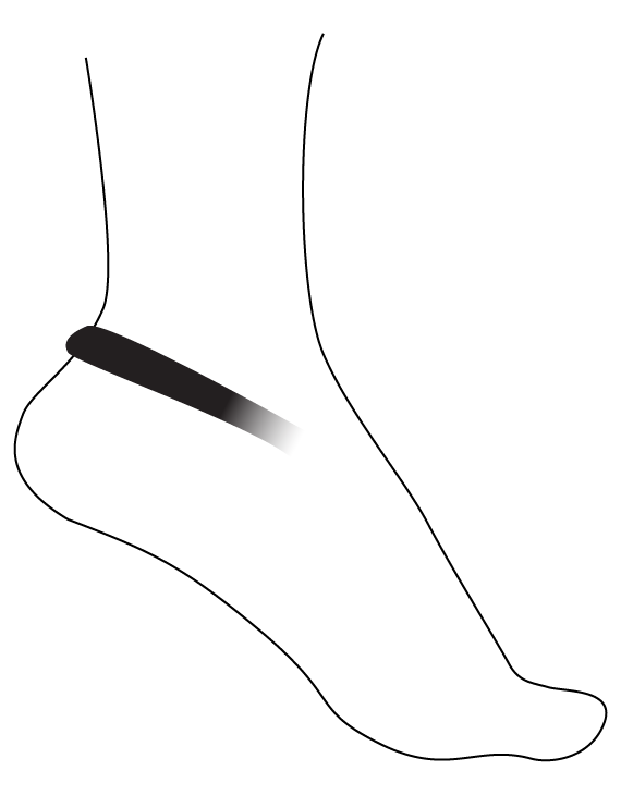 Drawing of a foot, with a black stripe from the upper instep to the back of the ankle.